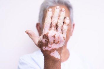 dermatologia-jimenez-vitiligo