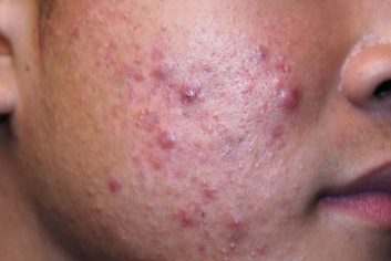 los-mejor-en-cuidado-del-acne-en-san-vicente-el-salvador