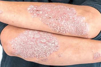 Psoriasis is a skin condition which causes red, crusty patches of skin covered with silvery scales called plaques to appear on one’s body. However, it is not infectious.