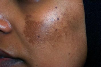 tratamiento-melasma-el-salvador